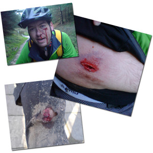 Mountain bike injuries from Dalby Forest mountain-bike-injuries