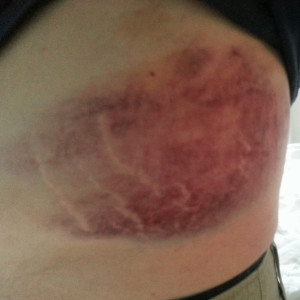 mountain-bike-injury-massive-bruise